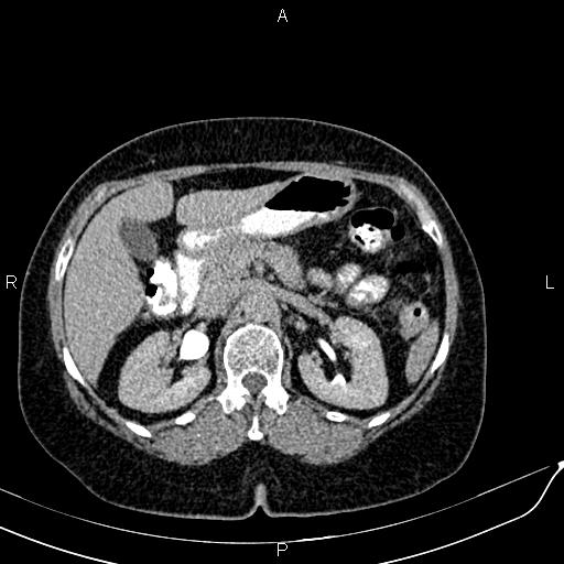 File:Bilateral ovarian serous cystadenocarcinoma (Radiopaedia 86062-101989 Axial C+ delayed 17).jpg