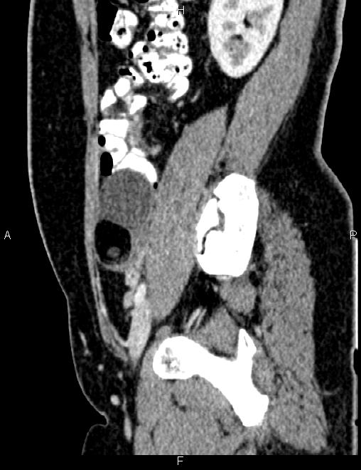 Bilateral ovarian teratoma (Radiopaedia 83131-97503 D 44).jpg