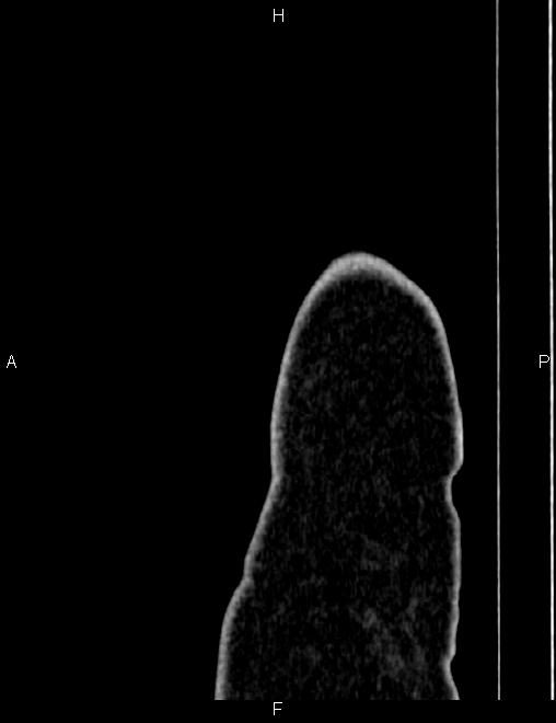 Bilateral ovarian teratoma (Radiopaedia 83131-97503 D 5).jpg