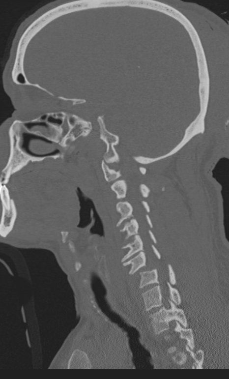 Bilateral perched facet joint (Radiopaedia 63149-71669 Sagittal bone window 44).jpg