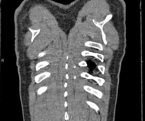 Bilateral pulmonary AVM (Radiopaedia 83134-97505 C 72).jpg