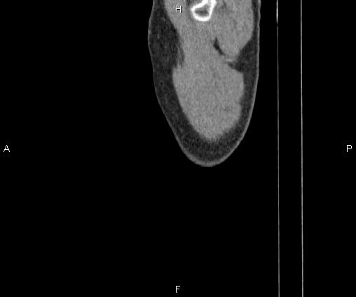 Bilateral pulmonary AVM (Radiopaedia 83134-97505 D 117).jpg