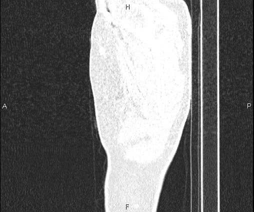 Bilateral pulmonary AVM (Radiopaedia 83134-97505 Sagittal lung window 11).jpg