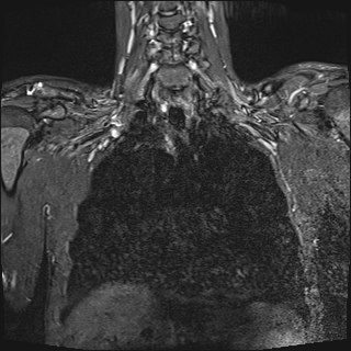 File:Bilateral spinoglenoid notch ganglion cysts (Radiopaedia 29577-30082 Coronal STIR 11).jpg