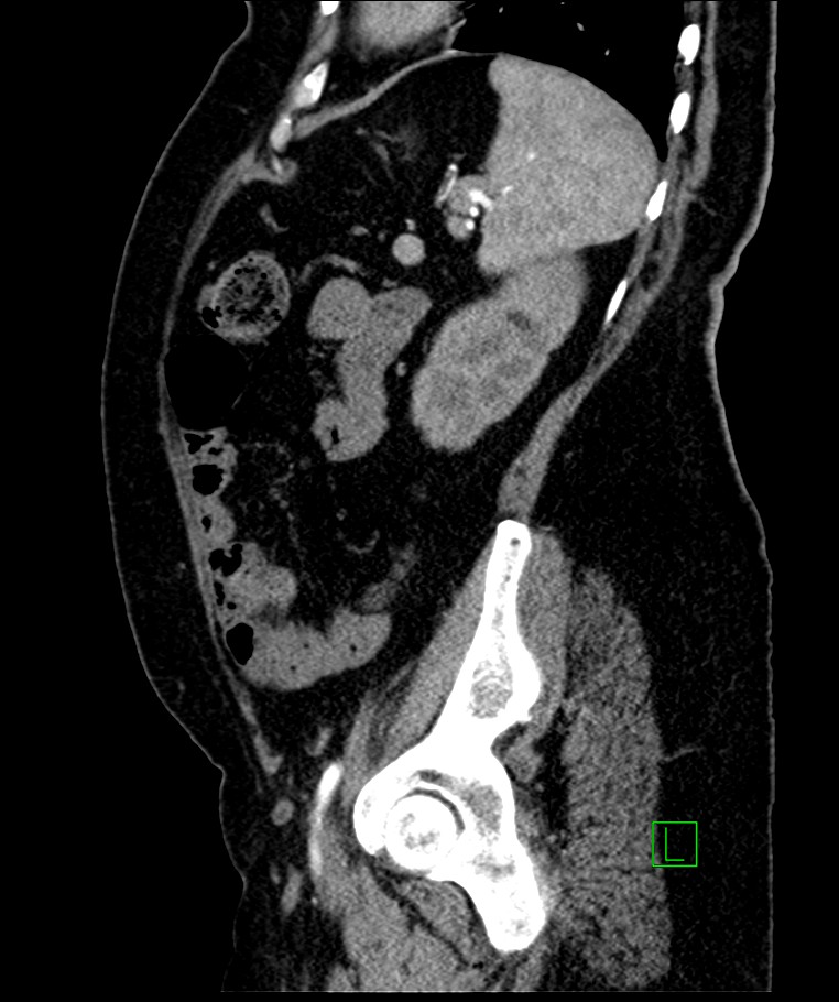 Bilateral sporadic synchronous clear cell renal cell carcinoma (Radiopaedia 85035-100575 E 37).jpg