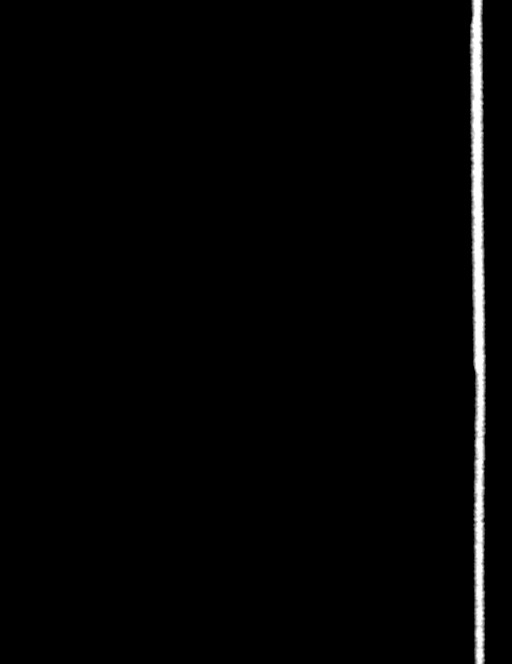 Bilateral staghorn calculi (Radiopaedia 59475-66842 Coronal non-contrast 100).jpg