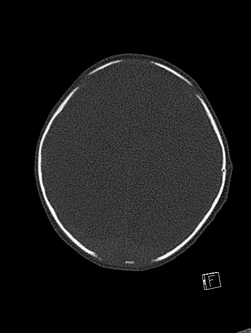 Bilateral subdural hemorrhage and parietal skull fracture (Radiopaedia 26058-26192 Axial bone window 30).png