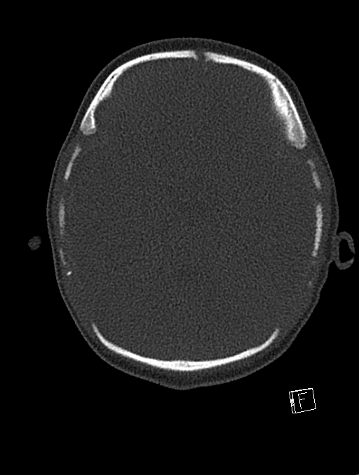 Bilateral subdural hemorrhage and parietal skull fracture (Radiopaedia 26058-26192 Axial bone window 88).png