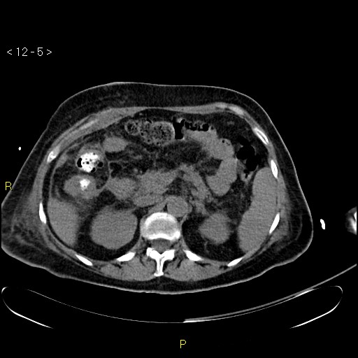 File:Biloma with drainage into the colon (Radiopaedia 20032-20068 B 14).jpg