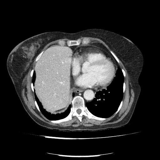 File:Bladder tumor detected on trauma CT (Radiopaedia 51809-57609 B 12).jpg