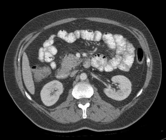 File:Bleeding duodenal ulcer and adenomyomatosis of gallbladder (Radiopaedia 61834-69861 A 51).jpg