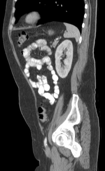 Bleeding duodenal ulcer and adenomyomatosis of gallbladder (Radiopaedia 61834-69861 C 75).jpg