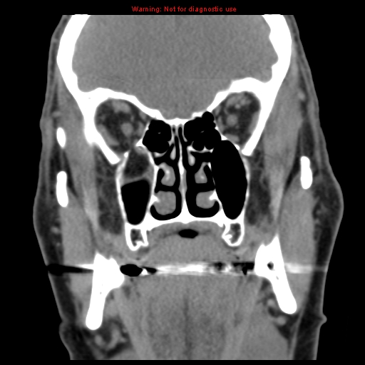 File:Blowout fracture with inferior rectus entrapment (Radiopaedia 12418-12673 Coronal non-contrast 15).jpg