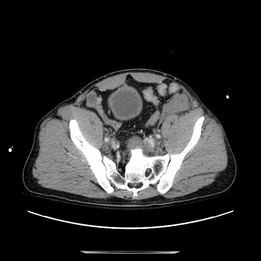Blunt abdominal trauma with solid organ and musculoskelatal injury with active extravasation (Radiopaedia 68364-77895 A 124).jpg