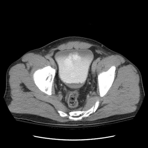 Blunt abdominal trauma with solid organ and musculoskelatal injury with active extravasation (Radiopaedia 68364-77895 Axial C+ delayed 122).jpg