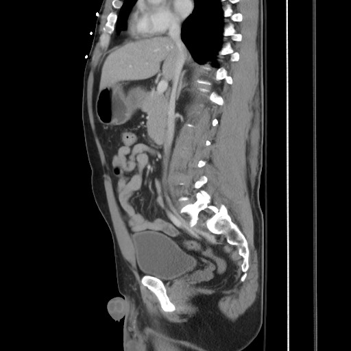 Blunt abdominal trauma with solid organ and musculoskelatal injury with active extravasation (Radiopaedia 68364-77895 C 67).jpg