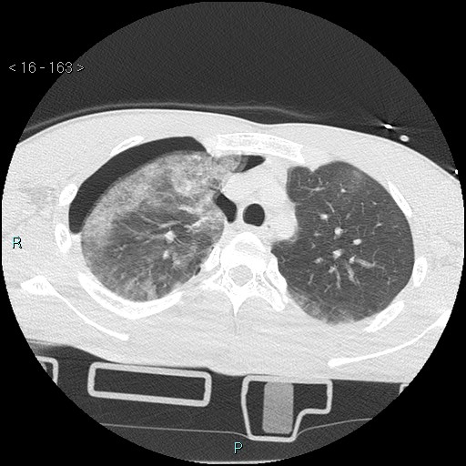 Blunt chest trauma (Swiss cheese sign) (Radiopaedia 38519-40618 Axial lung window 17).jpg