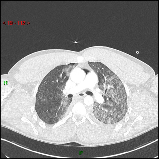 Blunt thoracic trauma (Radiopaedia 73454-84221 Axial lung window 42).jpg