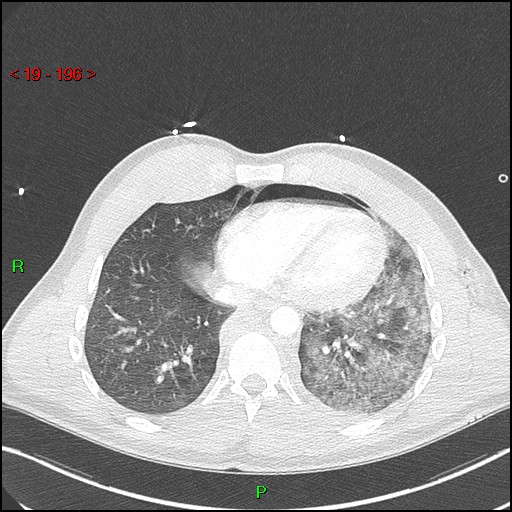 Blunt thoracic trauma (Radiopaedia 73454-84221 Axial lung window 72).jpg