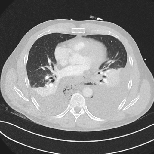 Boerhaave syndrome (Radiopaedia 39382-41660 Axial lung window 32).png