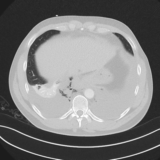 Boerhaave syndrome (Radiopaedia 39382-41660 Axial lung window 45).png