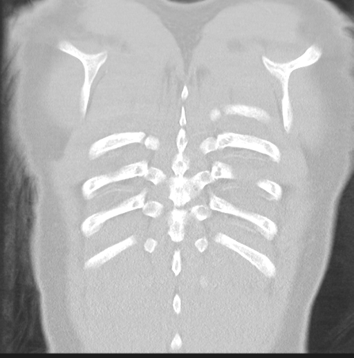 Boerhaave syndrome (Radiopaedia 39382-41661 Coronal lung window 47).png