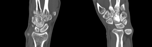 Bone islands - carpus (Radiopaedia 63141-71658 Coronal bone window 36).jpg