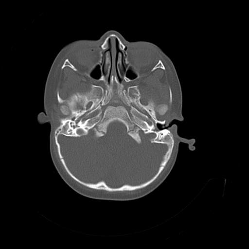 File:Bony atresia of the right external auditory canal (Radiopaedia 27916-28156 Axial bone window 4).jpg