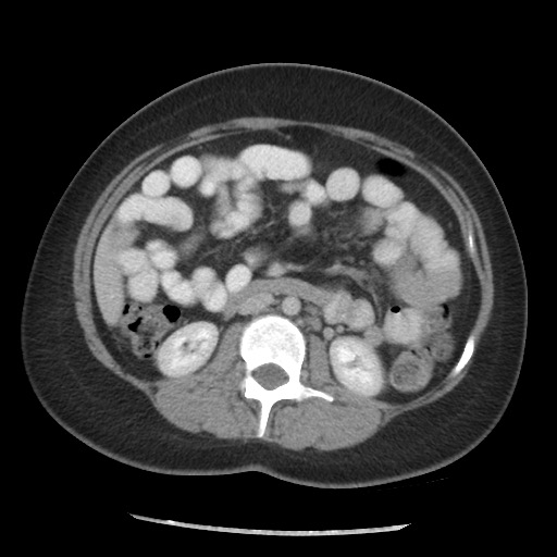File:Borderline mucinous tumor (ovary) (Radiopaedia 78228-90808 A 88).jpg