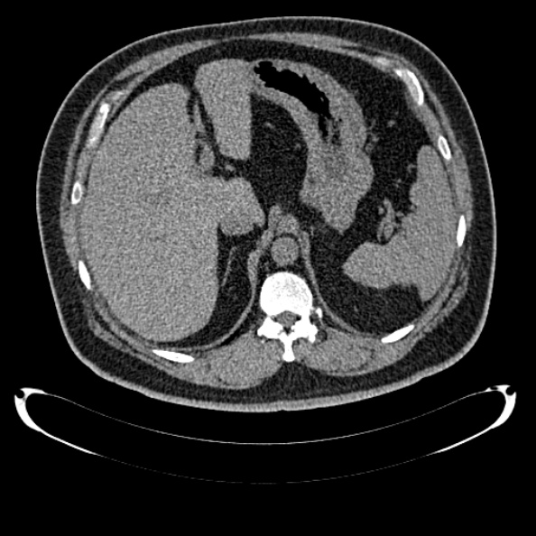 File:Bosniak renal cyst - type IV (Radiopaedia 24244-24518 Axial non-contrast 100).jpg