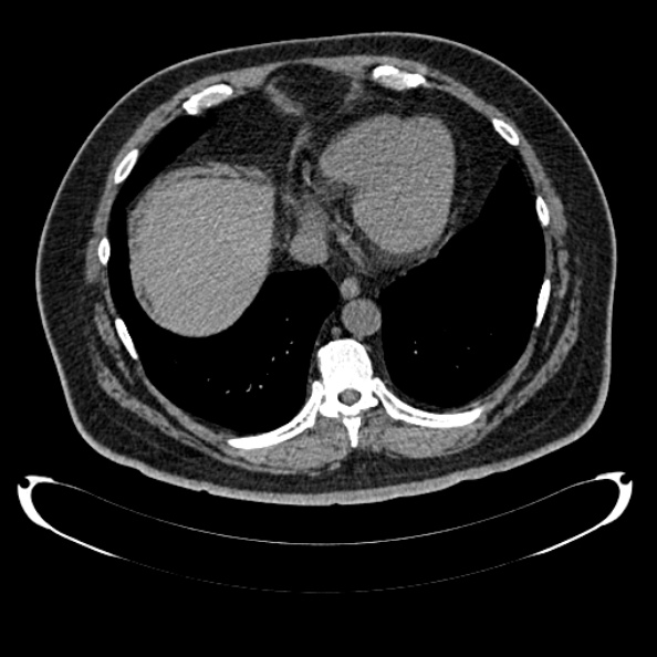 Bosniak renal cyst - type IV (Radiopaedia 24244-24518 Axial non-contrast 24).jpg