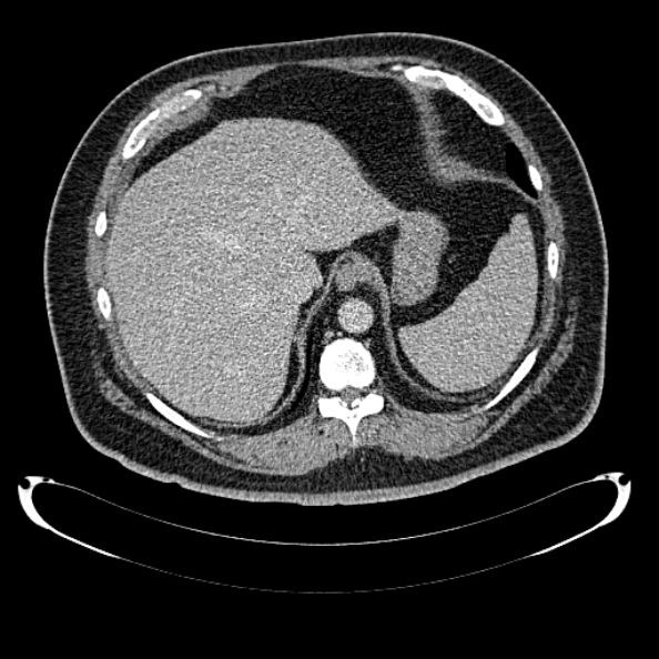 Bosniak renal cyst - type IV (Radiopaedia 24244-24518 C 42).jpg