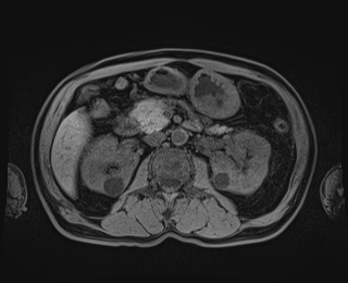 Bouveret syndrome (Radiopaedia 61017-68856 Axial T1 fat sat 41).jpg