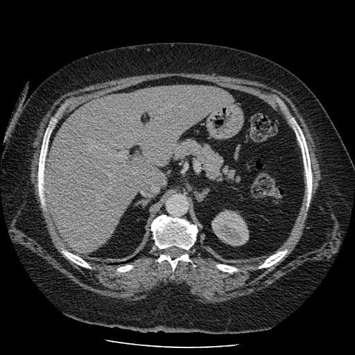 Bovine aortic arch - right internal mammary vein drains into the superior vena cava (Radiopaedia 63296-71875 A 180).jpg