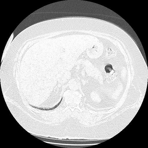 Bovine aortic arch - right internal mammary vein drains into the superior vena cava (Radiopaedia 63296-71875 Axial lung window 180).jpg