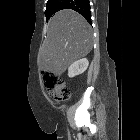 Bowel and splenic infarcts in acute lymphocytic leukemia (Radiopaedia 61055-68915 C 49).jpg