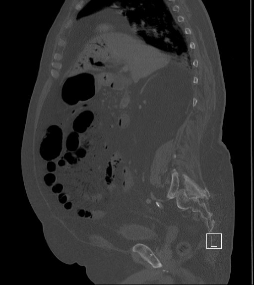 Bowel ischemia secondary to SMA occlusion with extensive portomesenteric venous gas (Radiopaedia 54656-60871 Sagittal bone window 67).jpg