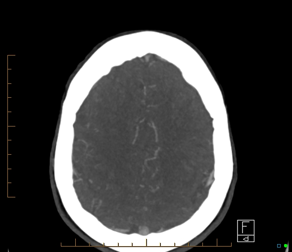 Brachiocephalic trunk stenosis (Radiopaedia 87242-103519 A 15).jpg