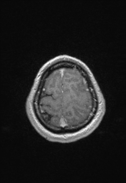 Brain abscess with ventriculitis (Radiopaedia 85703-101495 Axial T1 C+ 149).jpg