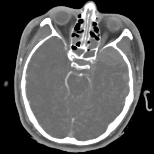 Brain contusions, internal carotid artery dissection and base of skull fracture (Radiopaedia 34089-35339 D 35).png