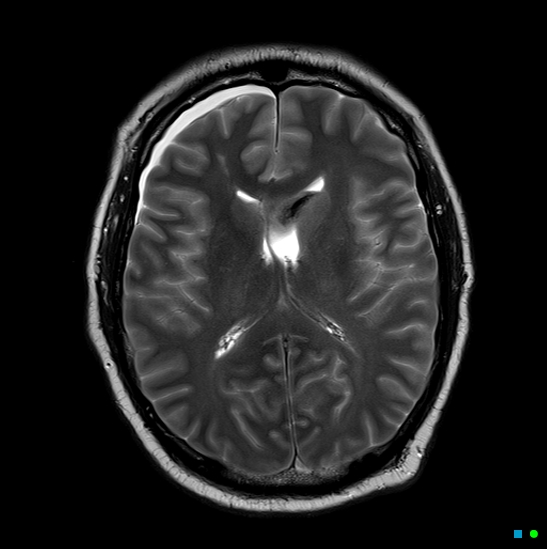 File:Brain death on MRI and CT angiography (Radiopaedia 42560-45689 Axial T2 19).jpg