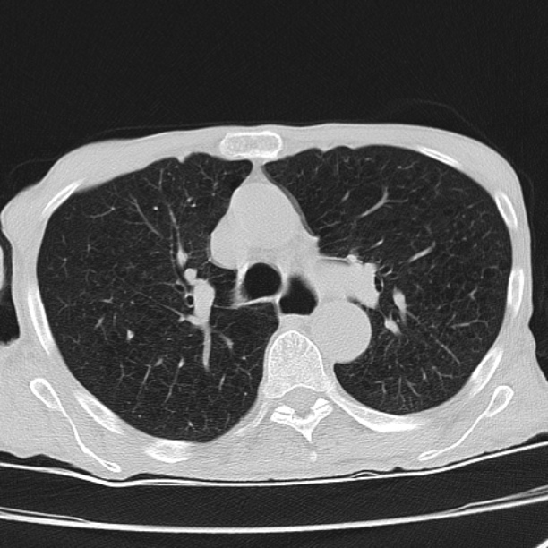 Brain metastases from lung cancer (Radiopaedia 27849-28093 Axial lung window 24).jpg