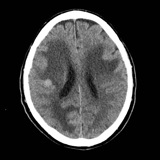 File:Brain metastases from lung cancer (Radiopaedia 83839-99027 Axial non-contrast 22).jpg
