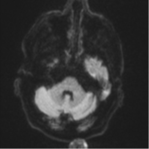 Brain metastasis (lung cancer) (Radiopaedia 48289-53179 Axial DWI 34).png