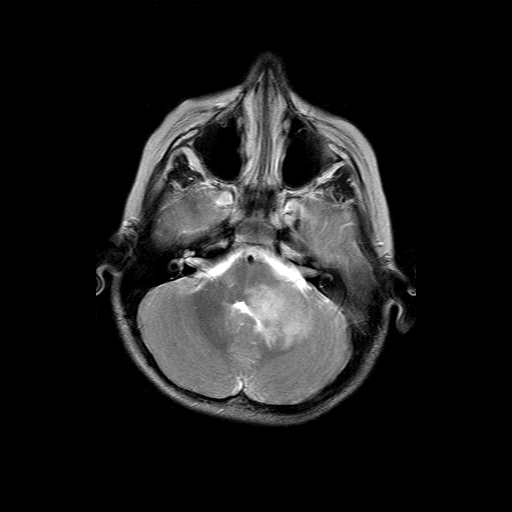 File:Brainstem ganglioglioma (Radiopaedia 10763-11224 Axial T2 15).jpg