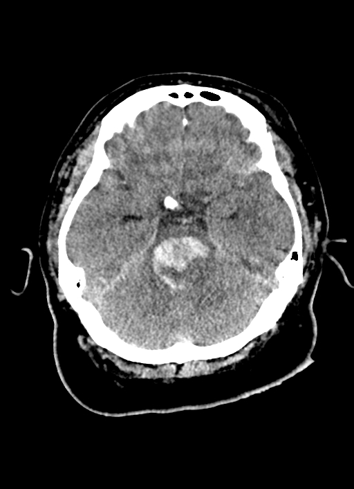 Brainstem hemorrhage (Radiopaedia 81294-94976 Axial non-contrast 42).jpg