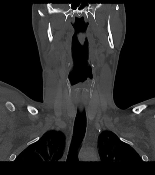 Branchial cleft cyst (Radiopaedia 31167-31875 Coronal bone window 32).jpg