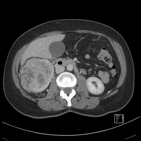 Breast metastases from renal cell cancer (Radiopaedia 79220-92225 C 45).jpg