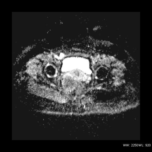 File:Broad ligament fibroid (Radiopaedia 49135-54241 Axial ADC 22).jpg