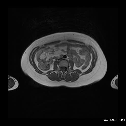 File:Broad ligament fibroid (Radiopaedia 49135-54241 Axial T1 1).jpg